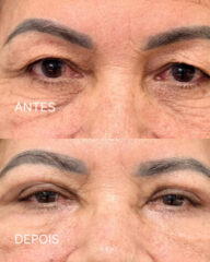 Antes e depois de blefaroplastia para redução de bolsas e excesso de pele