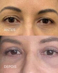 Antes e depois de blefaroplastia com melhora da flacidez palpebral