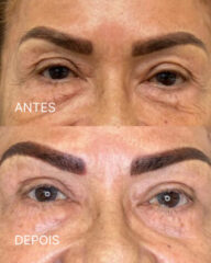 Comparativo antes e depois de blefaroplastia em paciente adulta