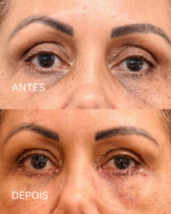 Antes e depois de correção do excesso de pele nas pálpebras