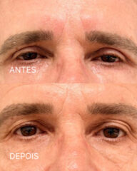 Antes e depois de blefaroplastia na região dos olhos em paciente adulta