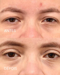Antes e depois de blefaroplastia superior e inferior na região dos olhos
