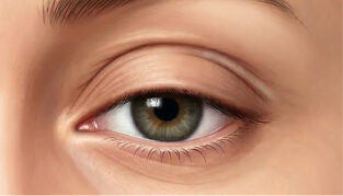 Ilustração de ptose palpebral com queda da pálpebra superior